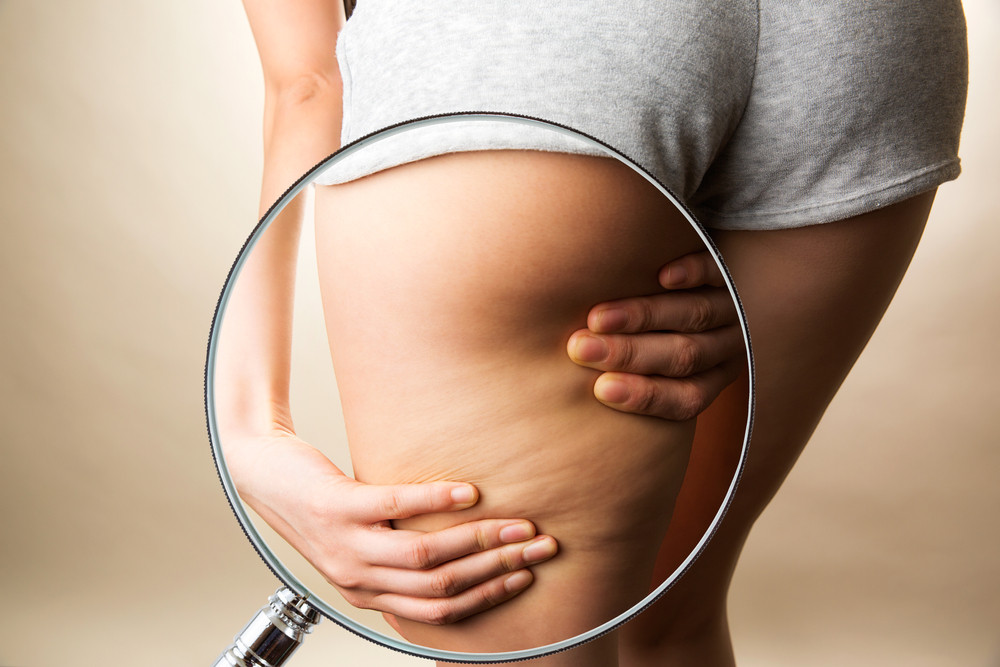 Cellulite : origine et conseils